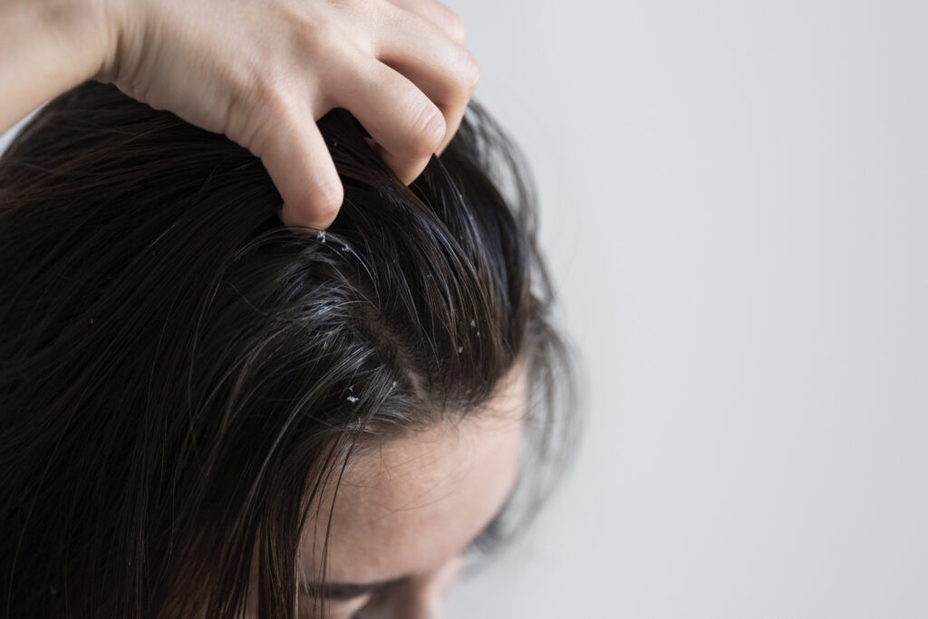 Summer Heat Can Cause Dandruff in Hair