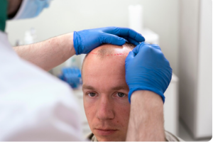 First PRP Hair Treatment