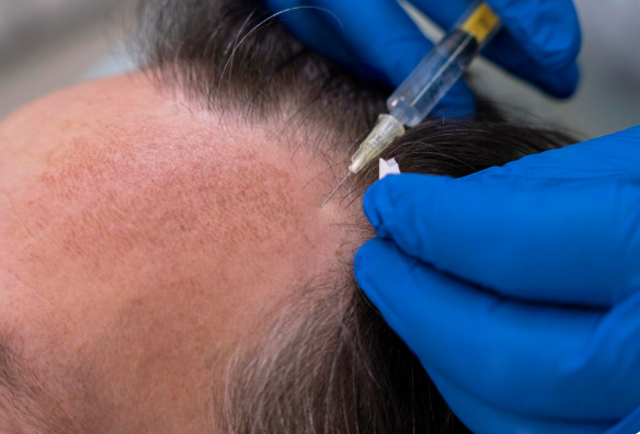 PRP Injection Hair Regrowth